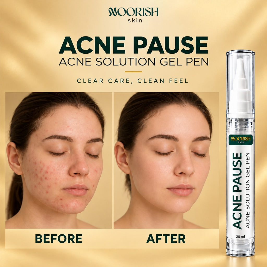 Noorish Skin Acne Pause – Acne Care Solution for Clearer-Looking Skin