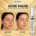 Noorish Skin Acne Pause – Acne Care Solution for Clearer-Looking Skin