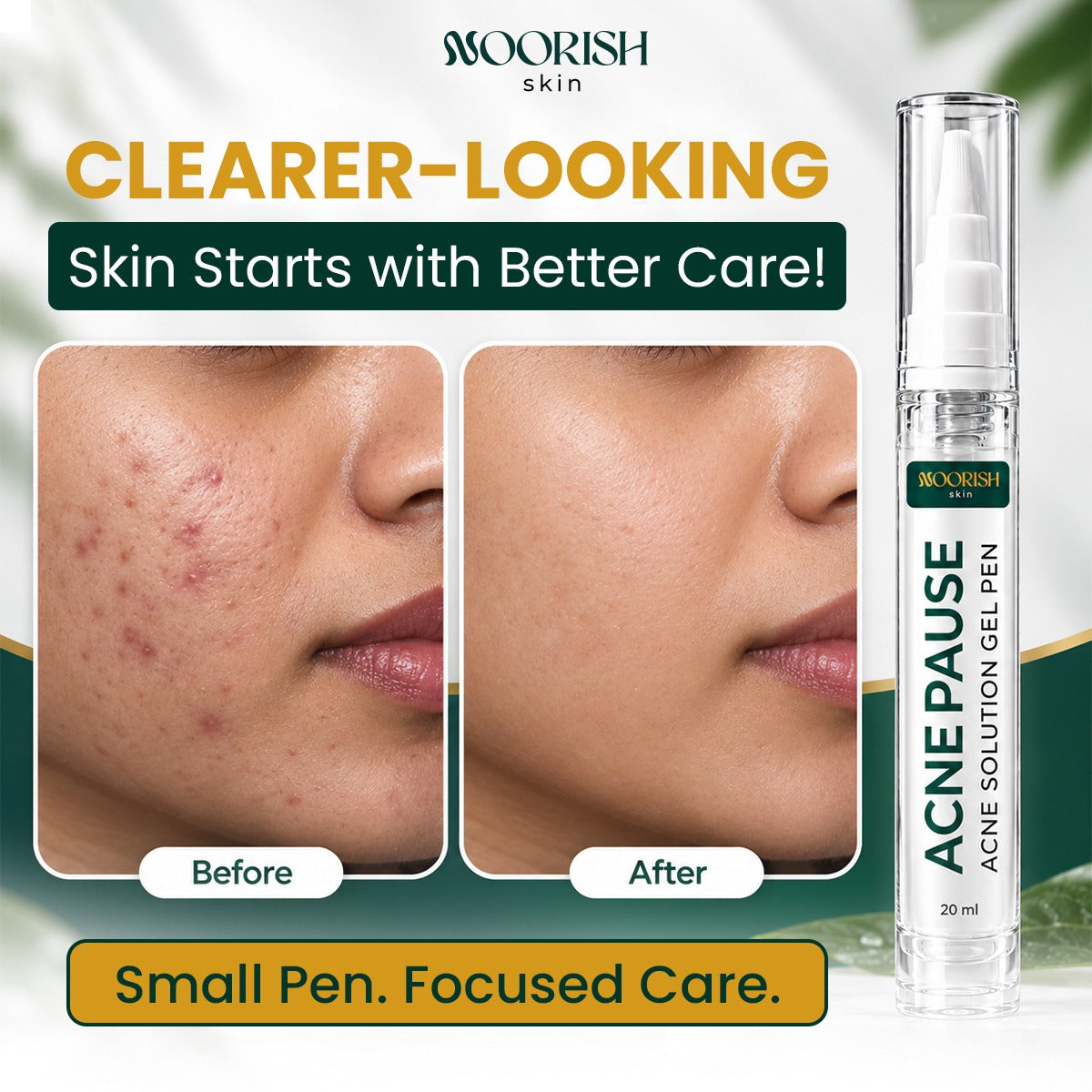 Noorish Skin Acne Pause – Acne Care Solution for Clearer-Looking Skin