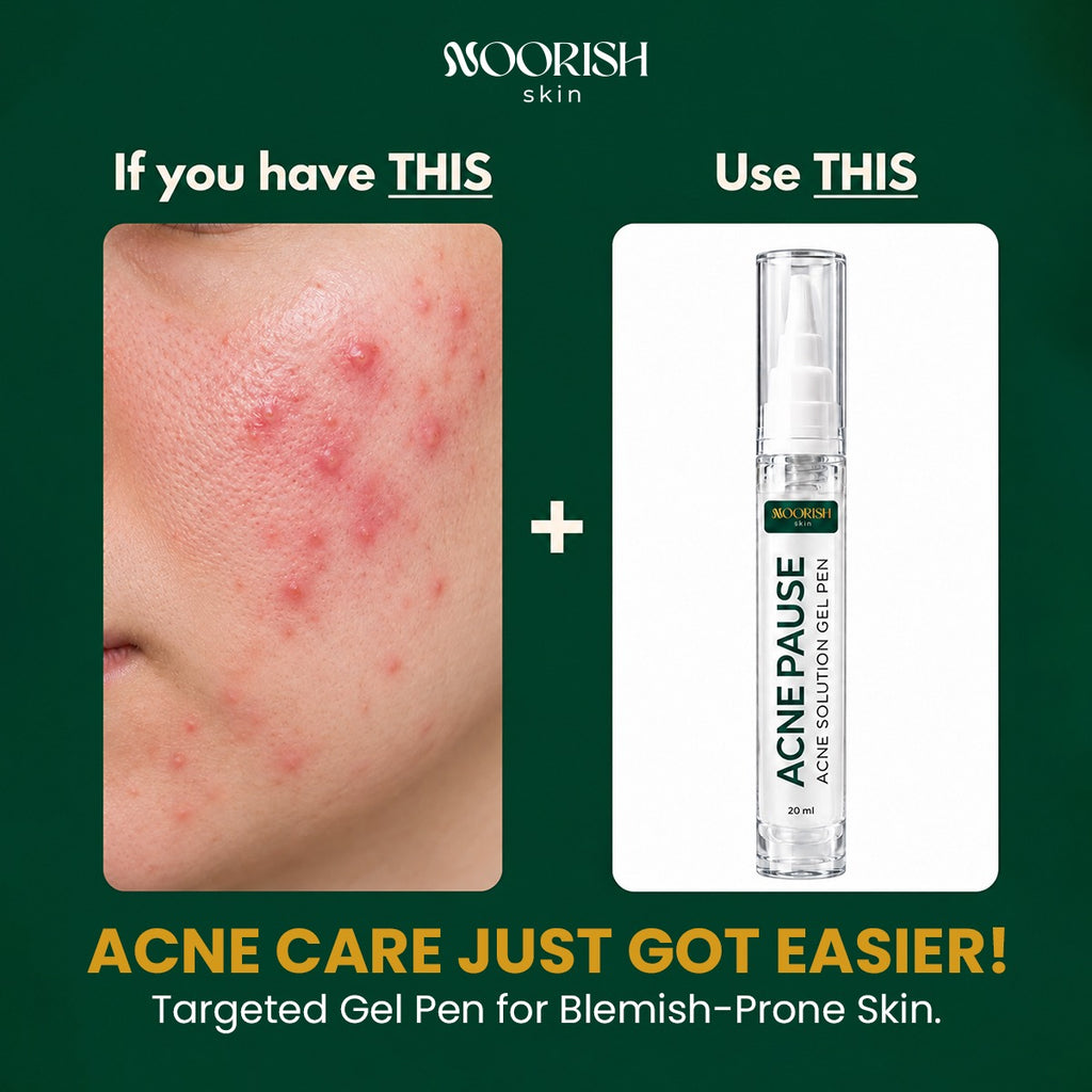 Noorish Skin Acne Pause – Acne Care Solution for Clearer-Looking Skin